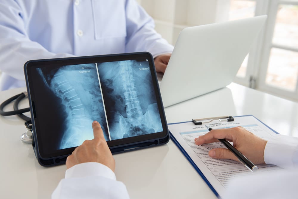 Osteofitose: o que é bico de papagaio